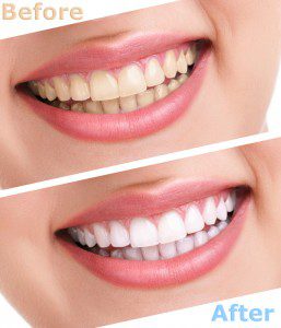 Laser Teeth Whitening