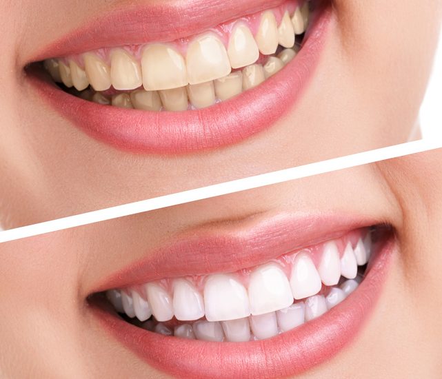 Laser Teeth Whitening
