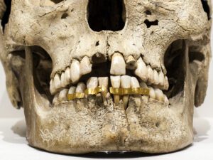 Etruscan attempt at dental restoration