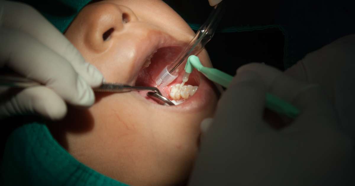 A dentist applies sealant to a child's teeth during a visit. The child wears a protective covering around their eyes.