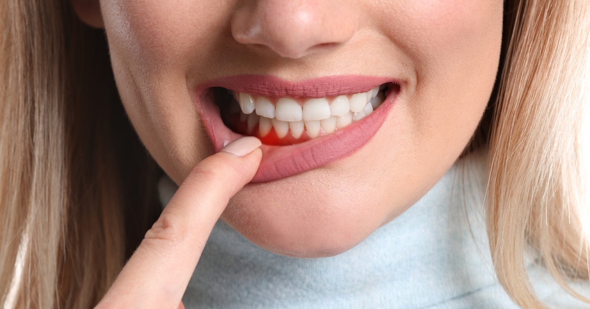 A woman pulls down her lip with her finger, revealing redness on the gums on her lower jaw. Her hair is blonde.